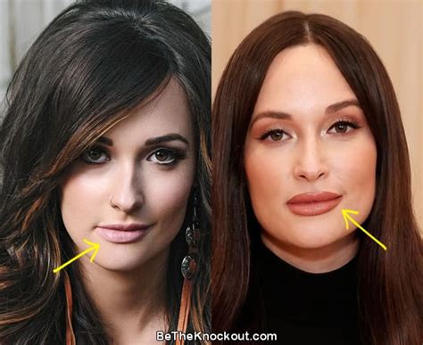 Kacey Musgraves Plastic Surgery Comparison Photos