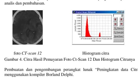 Peningkatan Citra Untuk Memperjelas Foto Brain Ct Scan