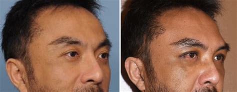 Male Custom Brow Implant Result Oblique View Dr Barry Eppley