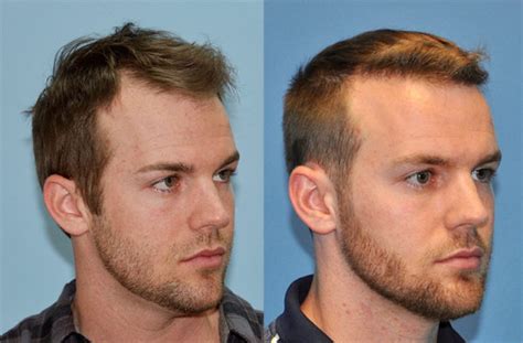 25 Year Old Male Hairline Restoration Carolina Hair Surgery