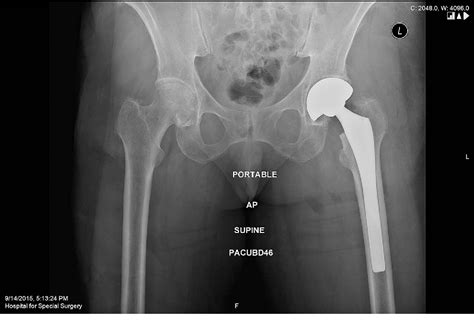 Figure From Total Hip Arthroplasty Dislocations Are More Complex Than