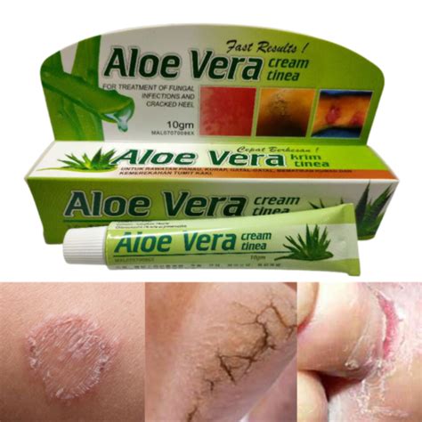 3x Aloe Vera Tinea Anti Fungal Treatment Cream Extra Strength Athlete Foot Ebay