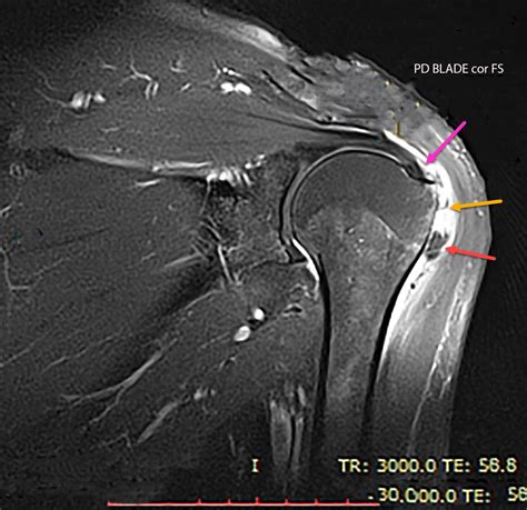 Calcific Tendinosis Radiology For Beginners By Dr Samuel Kobba