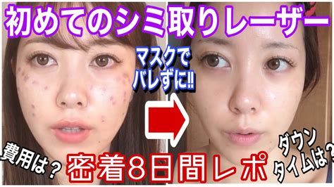 【シミ取り】レーザー治療8日間密着レポ【ダウンタイム】 美容コスメ情報局