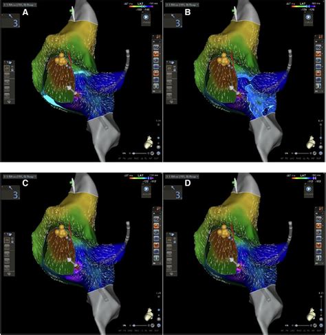 Atrioventricular Nodal Reentry Tachycardia Treatment Using Carto V