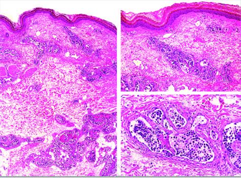 Intravascular Large B Cell Lymphoma Accumulation Of Large Neoplastic Download Scientific