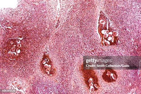 Schistosomiasis Photos And Premium High Res Pictures Getty Images