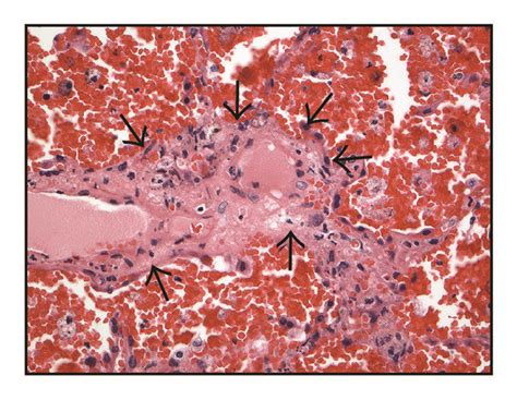 Lung With Diffuse Alveolar Hemorrhage H E Stain A Area In Which