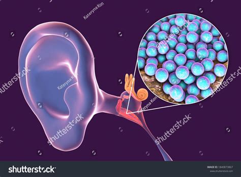 Ilustrasi Stok Otitis Media Caused By Bacteria Staphylococcus