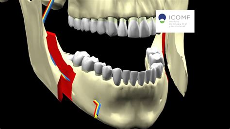 tempo Analítico Óptima osteotomía sagital de rama mandibular en cirugía