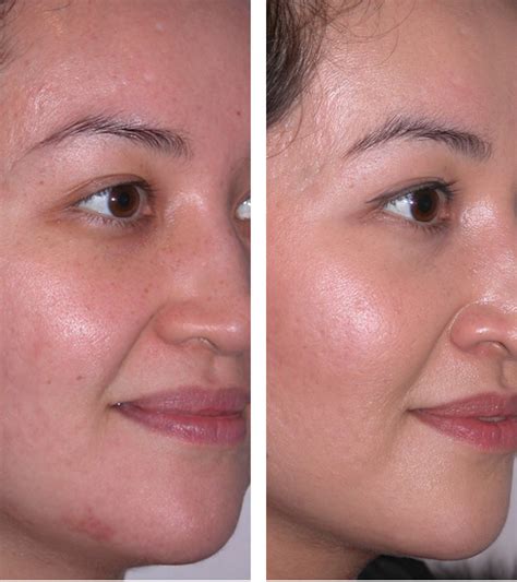 Albums 94 Pictures Before And After Pictures Of Microdermabrasion Sharp