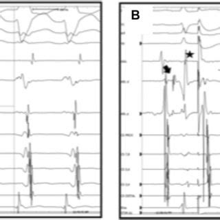 D Electro Anatomical Activation Map Of A Para Hisian Accessory Pathway