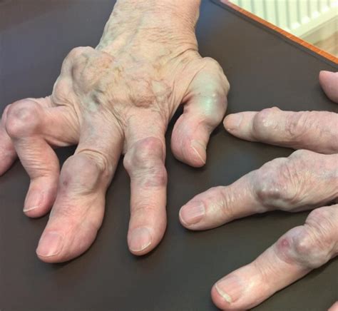 Rheumatoid Arthritis Nodules