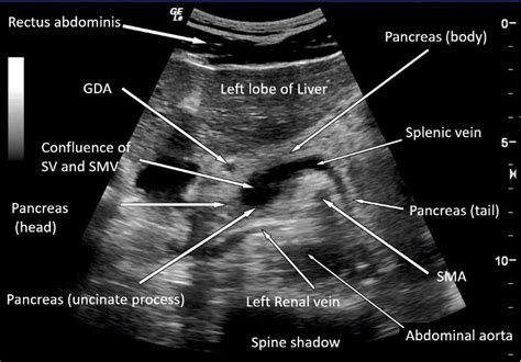 Pancreas Ultrasound