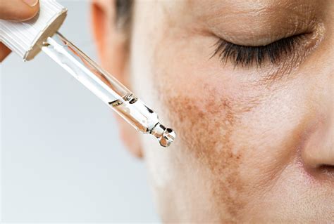 Cómo Eliminar El Melasma Para Siempre Blog Cliniem