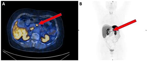 Diagnostics Free Full Text Role Of Petct And Therapy Management Of