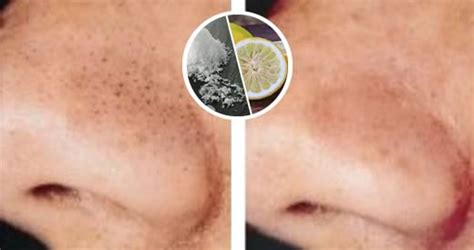 Come eliminare i punti neri per sempre con sale e limone