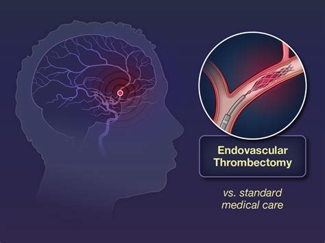 Endovascular Thrombectomy For Large Ischemic Strokes New England