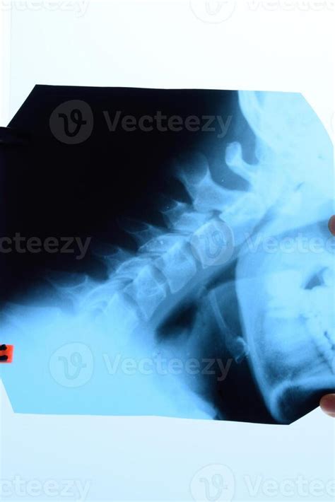 X-ray of the cervical vertebrae. X ray image of the cervical spine. 38459045 Stock Photo at Vecteezy