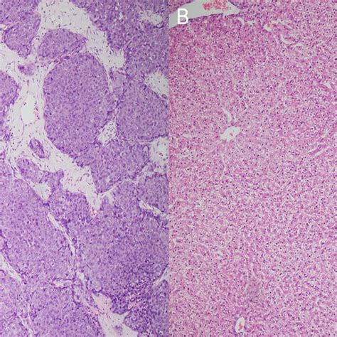 Hande Staining Of Liver Cancer And Liver Tissue A The Hande Stained Download Scientific Diagram