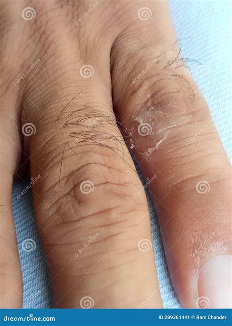 Ringworm Infection Or Tinea Corporis On Skin Isolated On White