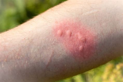 4000 Nettle Rash Stock Photos Pictures And Royalty Free Images Istock