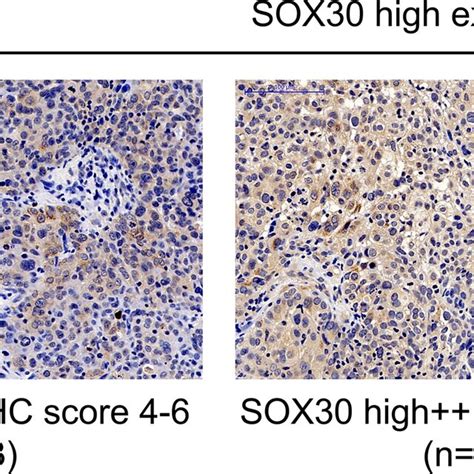 Immunohistochemistry Analysis Of Sox30 Expression In Breast Cancer