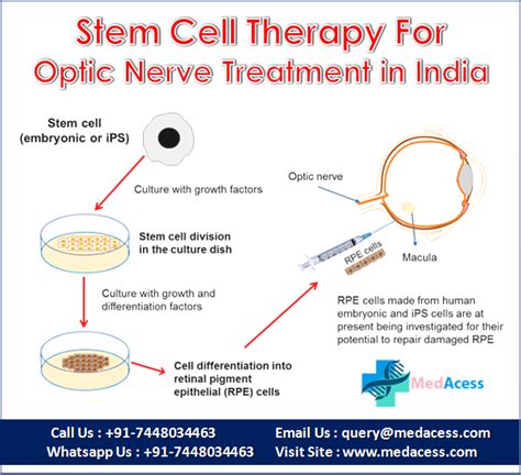 optic nerve atrophy treatment in India - Social Social Social | Social ...