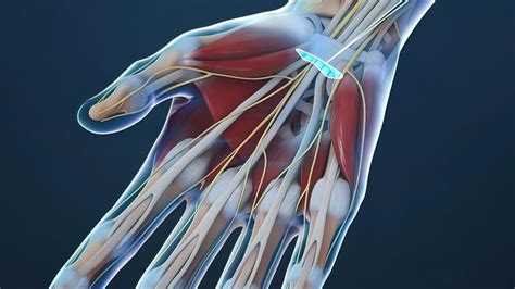 Scientists Developed A Non Surgical Treatment Model For Carpal Tunnel