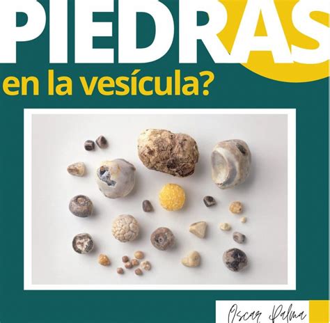 Piedras en la vesícula