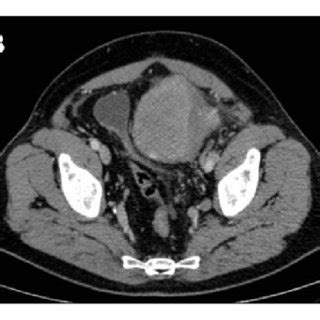 Contrast Enhanced Computed Tomography CT Scan Axial View Shows