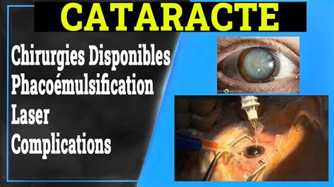 Cataracte Traitement Chirurgies Phaco Mulsification Laser