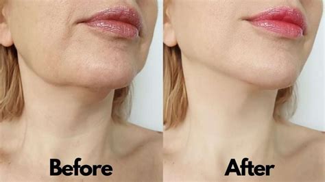 Chicago Facial Contouring And Jawline Sculpting Face Sculpting