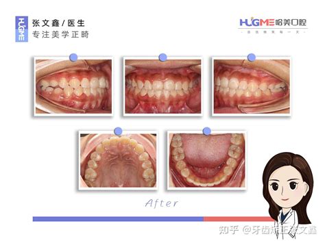 儿童地包天的早期矫正 知乎