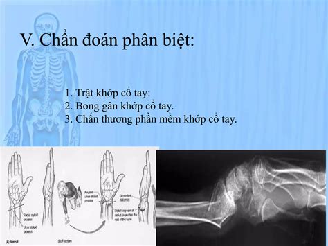 B5 gay pouteau û colle BỆNH NGOẠI KHOA PPT