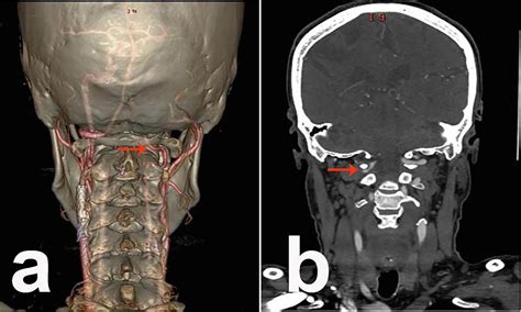 Surgicoanatomical Aspect In Vascular Variations Of The V3 Segment Of Vertebral Artery As A Risk