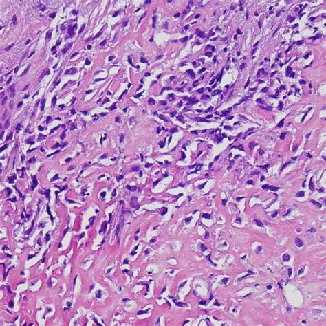 Peritoneal Tumor Consists Of Primitive Malignant Cell And Osteoid Hande