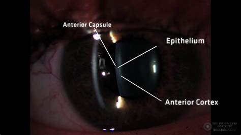 Slit Lamp Techniques Optical Section Of Crystalline Lens Youtube