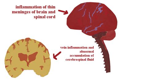 Meningitis complications in children | General center | SteadyHealth.com