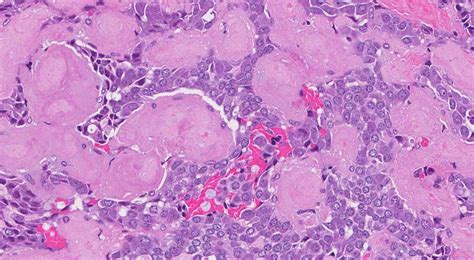 Medullary Thyroid Carcinoma Atlas Of Pathology