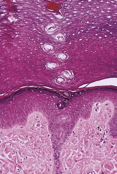 Aquagenic Syringeal Acrokeratoderma Report Of Two Teenage Cases