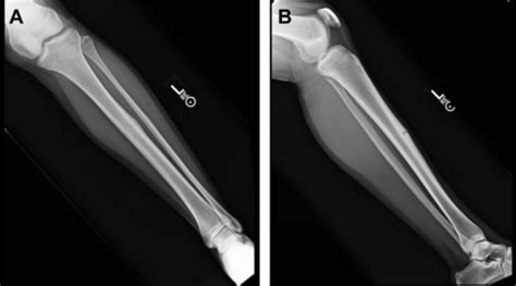 Tibial Stress Fracture