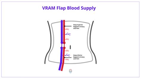 VRAM Flap Indications Anatomy Technique Images