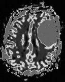 Extra Axial Masses Radiology Key