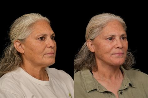 Patient 327857 Changes Rapid Lift Before And After Photos Changes