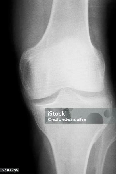 Lutut Dan Meniskus Cedera Xray Scan Foto Stok Unduh Gambar Sekarang