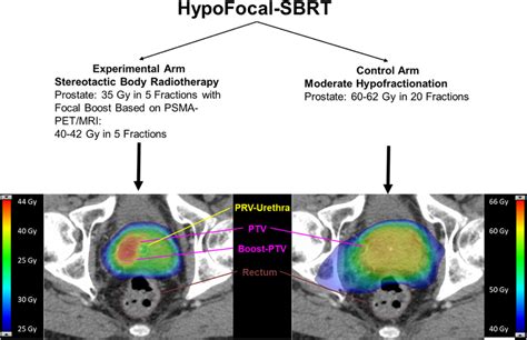 Scheme Of The Hypofocal Sbrt Trial And Examples Of Focal Dose Escalated