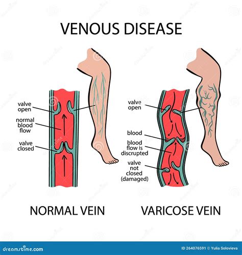 Varicose Veins Venous Disease Of Human Medicine Education Stock