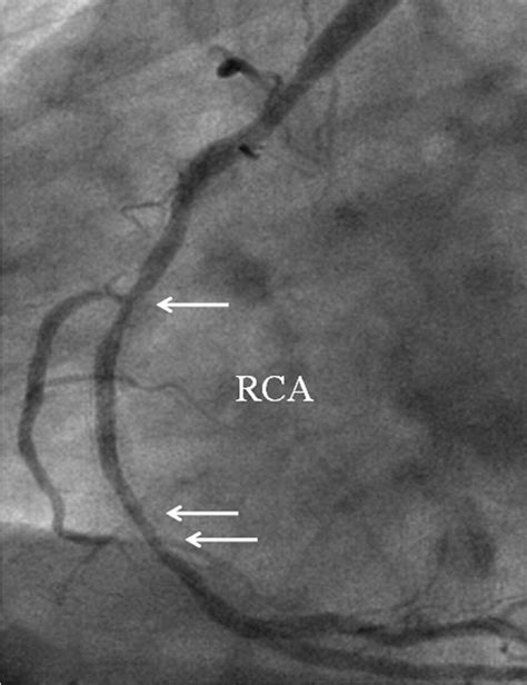 Coronary In Stent Restenosis Assessment With Ct Coronary Angiography