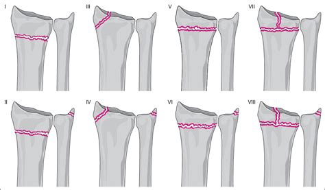 Trauma Of The Distal Forearm Radiology Key